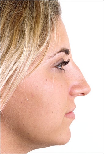 Rhinoplasty before 1023317