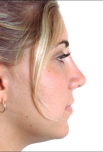 Rhinoplasty after 1023317