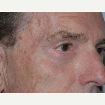 Eyelid Surgery after 3346409