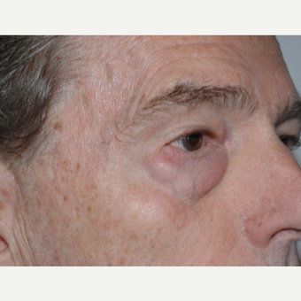 Eyelid Surgery before 3346409