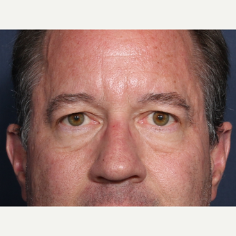 55-64 year old man treated with Eyelid Surgery (view 1 of 2) before 3809843