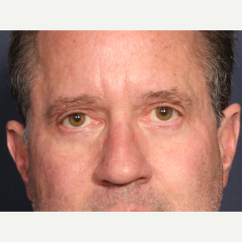 55-64 year old man treated with Eyelid Surgery (view 1 of 2) after 3809843