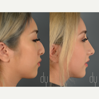 Asian Rhinoplasty with rib cartilage and DCF before 3129817
