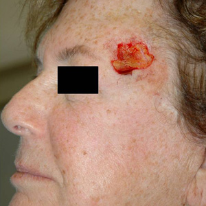 Mohs Surgery before 3711246