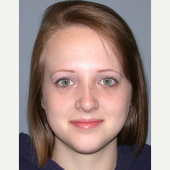 18-24 year old woman treated with Rhinoplasty after 3710452