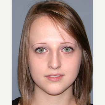 18-24 year old woman treated with Rhinoplasty before 3710452