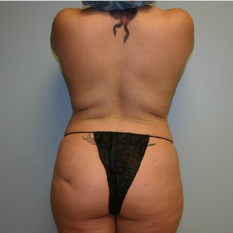 Brazilian Butt Lift before 3667595