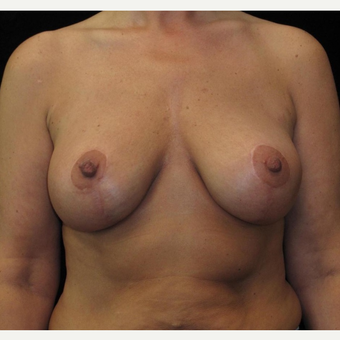 48 year old woman treated with Breast Lift with Implants after 3252553