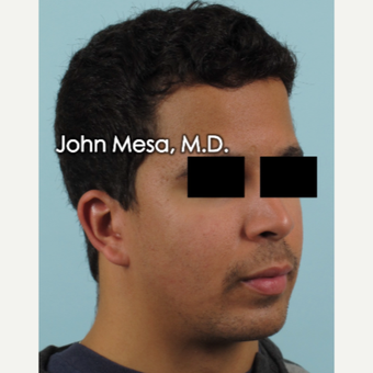 18-24 year old treated with Buccal Fat Removal and placement of mandible angle medpore implant before 3266808