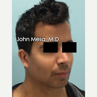18-24 year old treated with Buccal Fat Removal and placement of mandible angle medpore implant after 3266808