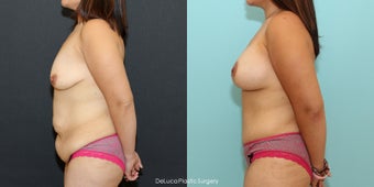 Mommy Makeover (350cc Saline + Abdominoplasty) after 1520474