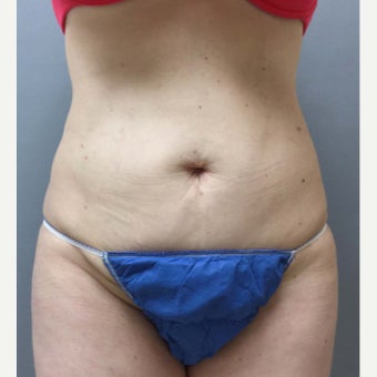 46 year old woman treated with Mini Tummy Tuck, liposuction to circumferential trunk and BBL after 1851615