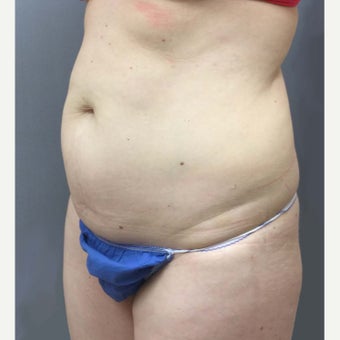 46 year old woman treated with Mini Tummy Tuck, liposuction to circumferential trunk and BBL 1851615