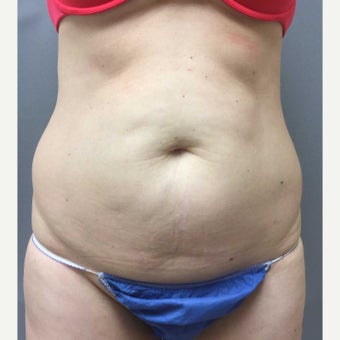 46 year old woman treated with Mini Tummy Tuck, liposuction to circumferential trunk and BBL before 1851615