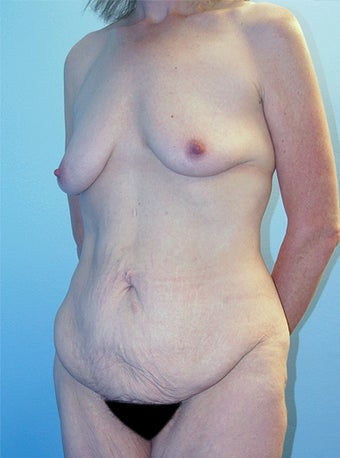 Body Lift 216779