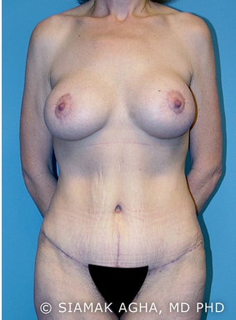 Body Lift after 216779