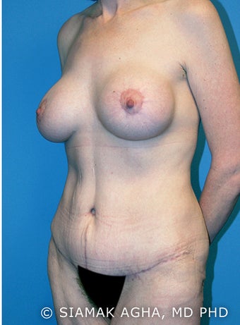 Body Lift 216779