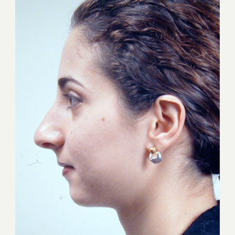18-24 year old woman treated with Rhinoplasty before 3686983
