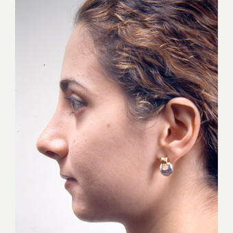 18-24 year old woman treated with Rhinoplasty after 3686983