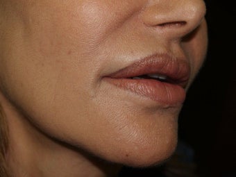 Lip Repair/Silicone Removal after 398105