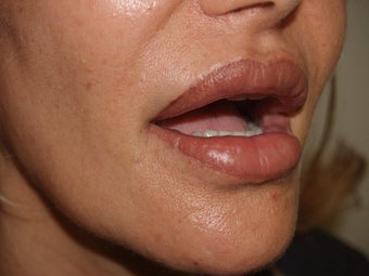 Lip Repair/Silicone Removal before 398105