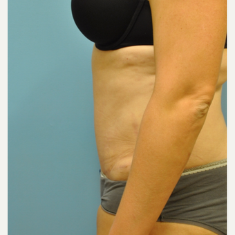 33 year old woman treated with Tummy Tuck after 3583974