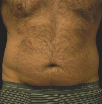 Liposucction of the Abdomen and Waist using Smart Lipo MPX before 392682
