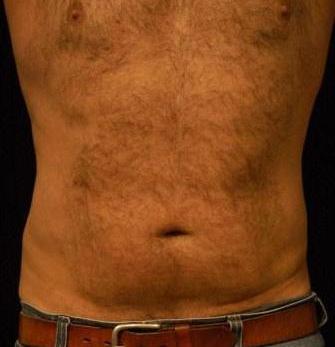 Liposucction of the Abdomen and Waist using Smart Lipo MPX after 392682