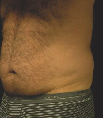 Liposucction of the Abdomen and Waist using Smart Lipo MPX 392682