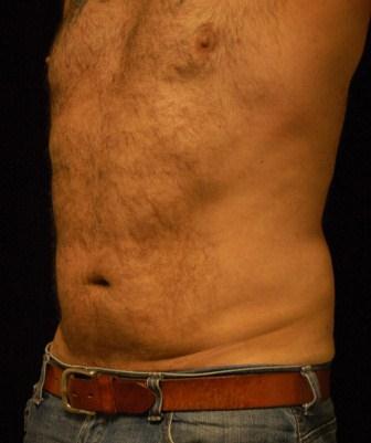 Liposucction of the Abdomen and Waist using Smart Lipo MPX 392682