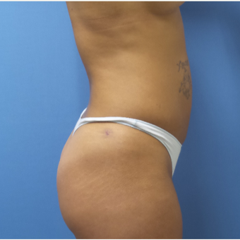 35-44 year old woman treated with Smart Lipo after 3097421