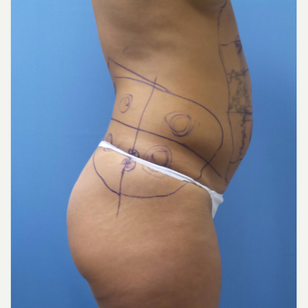 35-44 year old woman treated with Smart Lipo before 3097421