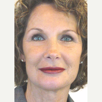 55-64 year old woman treated with Non Surgical Face Lift - FAMI Technique after 2854617