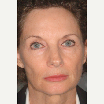 55-64 year old woman treated with Non Surgical Face Lift - FAMI Technique before 2854617