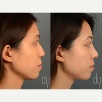 Asian Rhinoplasty with DCF before 3129948