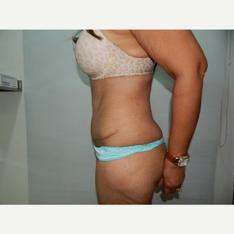 45-54 year old woman treated with Tummy Tuck 1590221