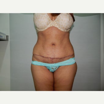 45-54 year old woman treated with Tummy Tuck after 1590221