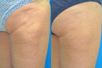 60 Year Old Female Treated for Cellulite before 657320