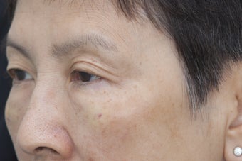 Undereye rejuvenation using Belotero with cannula after 1450936
