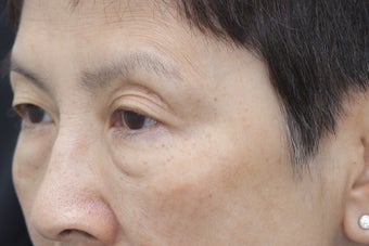Undereye rejuvenation using Belotero with cannula before 1450936