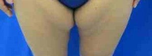 Thigh Lift before 3094377