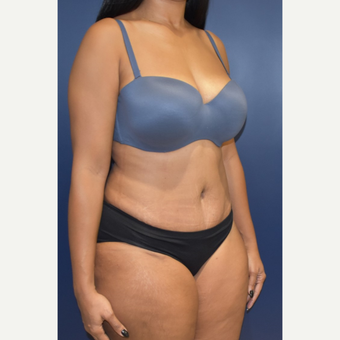 25-34 year old woman treated with Tummy Tuck after 3844752