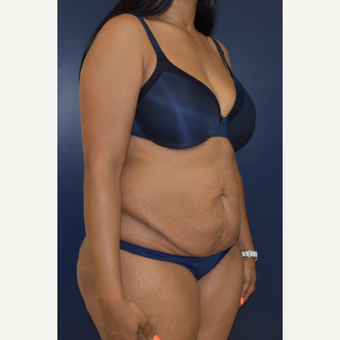 25-34 year old woman treated with Tummy Tuck before 3844752