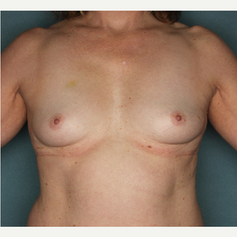 45-54 year old woman treated with Breast Augmentation before 3520756