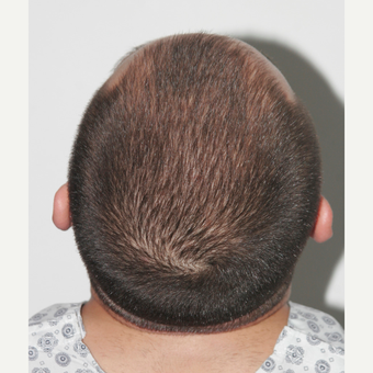 26 years old man treated with FUE Hair Transplant before 3068901