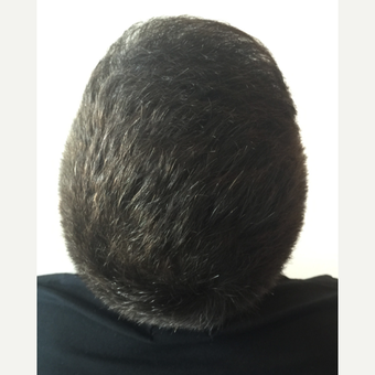 26 years old man treated with FUE Hair Transplant after 3068901