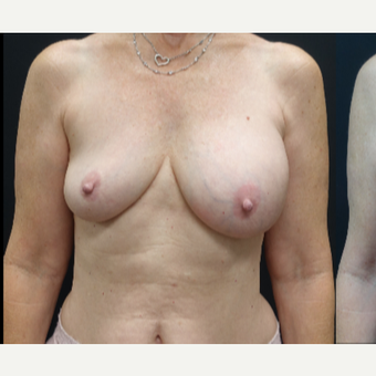 35-44 year old woman treated with Breast Implant Revision before 3731537