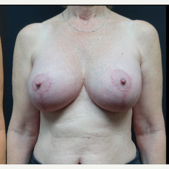 35-44 year old woman treated with Breast Implant Revision after 3731537