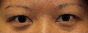 Double eyelid surgery before 3166895