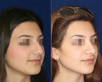 Nose Surgery before 1430613